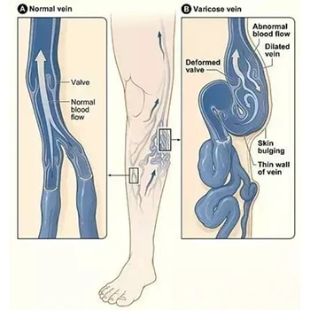 20pcs deževnike vaskulitis obliž krčne žile mavca vaskulitis noge kisline bilges srbenje earthworm noge, otekanje spodnjih okončin
