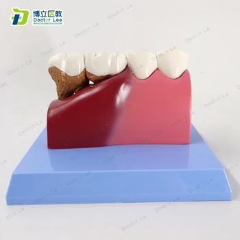 Bolnih Zob Model za Zobozdravstveno Študija, Poučevanja in Zobozdravnik Sporočilo