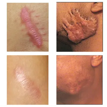4pcs Scar Removal Cream Acne Scar Zdravljenje Strij Revomal Koža Popravila Glajenje Zob Navlažijo Telo Brazgotin za Nego Kože